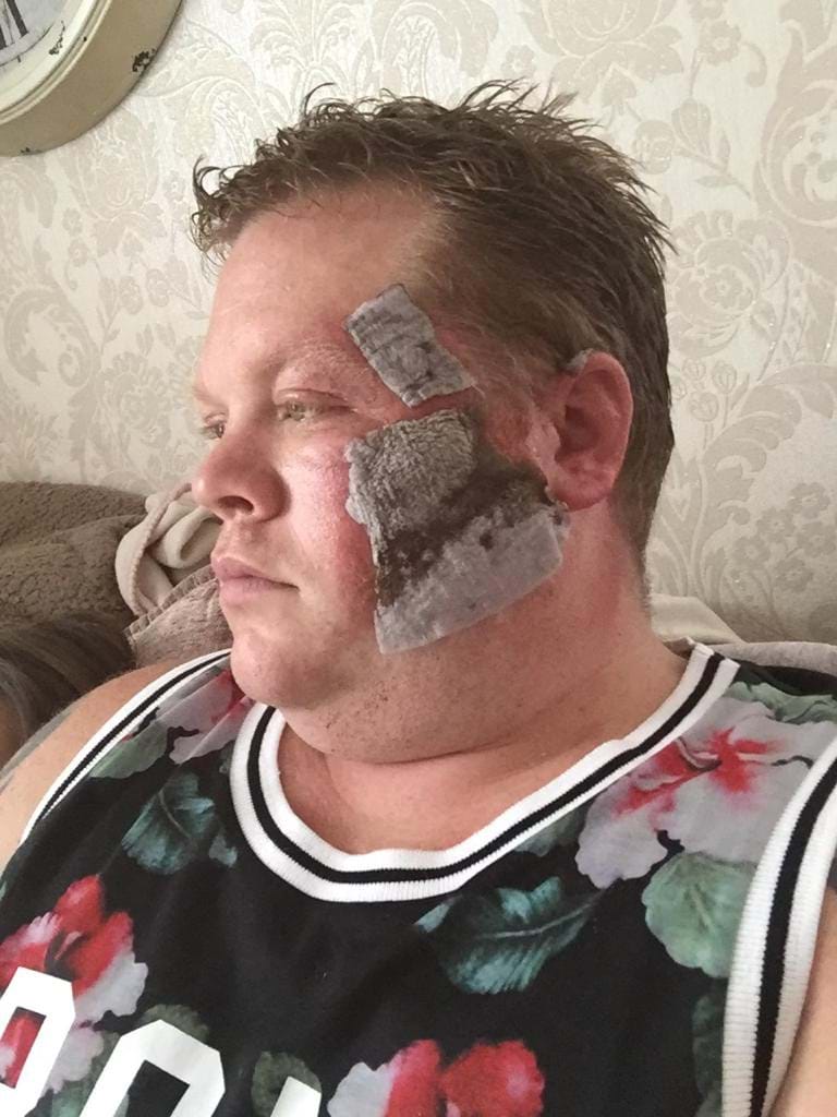 James Grant in his living room with his burns on his face covered up.